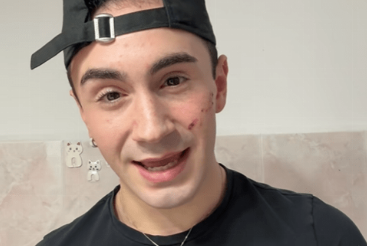 Genova, 19enne denuncia aggressione omofoba: colpito al volto con un coltellino Genova, 19enne denuncia aggressione omofoba: colpito al volto con un coltellino