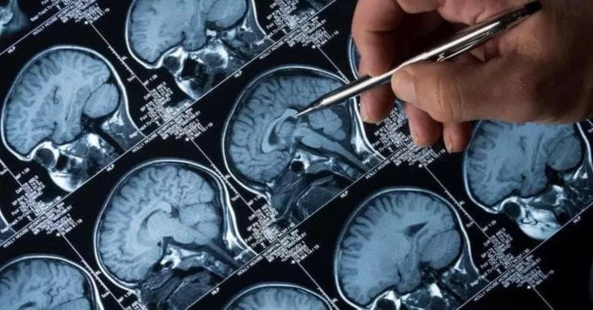 Alzheimer, il nuovo protocollo europeo: undici indizi per smascherare la malattia