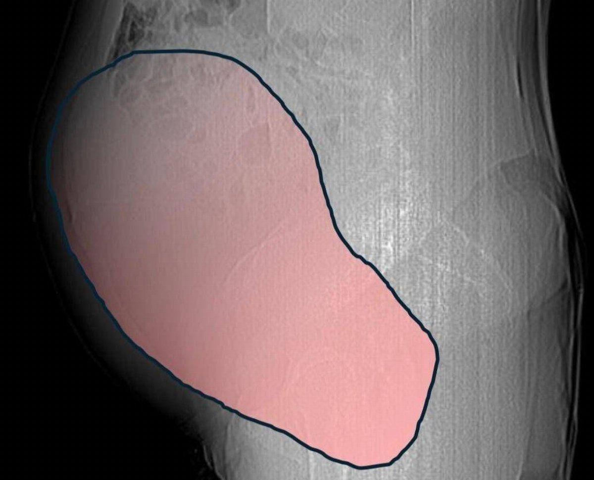 Torino, intervento straordinario al Sant