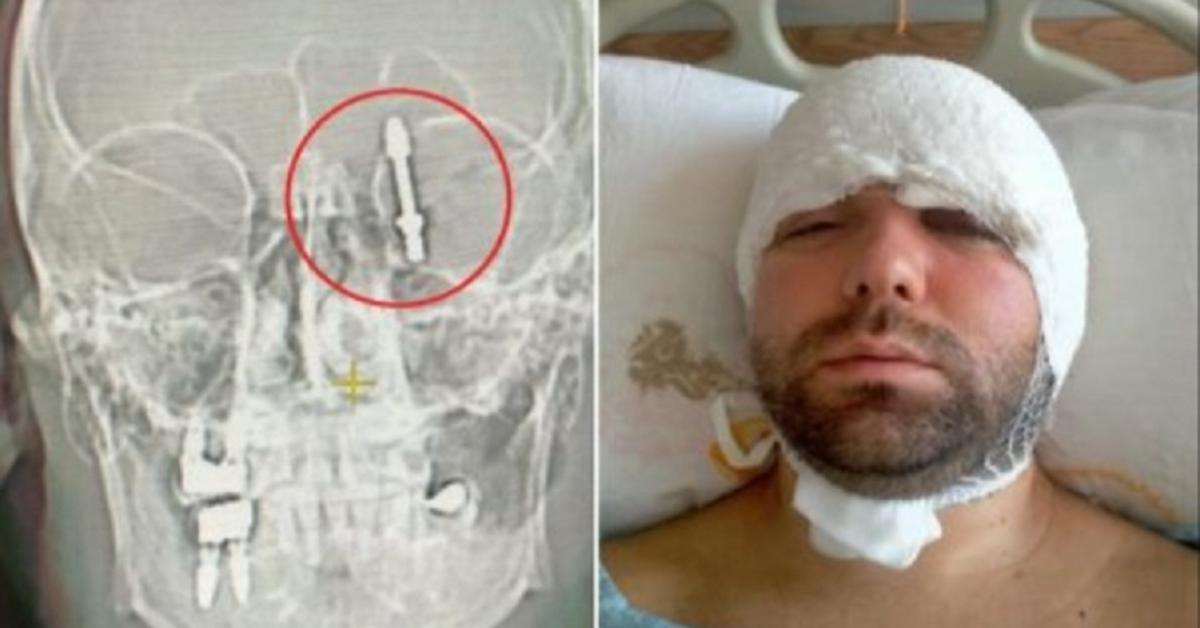 Turchia: vite si conficca nel cranio di un paziente durante implantologia