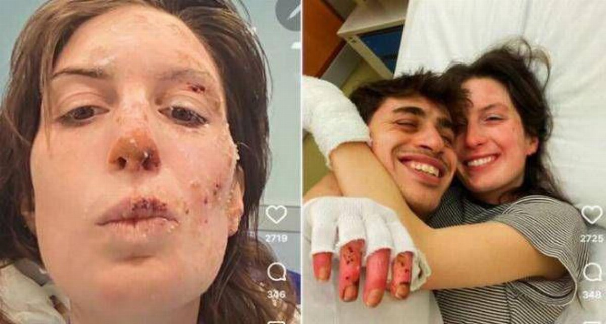 Crans-Montana, dimessi due studenti a Milano: cure ancora lunghe. Eleonora Palmieri mostra le ustioni