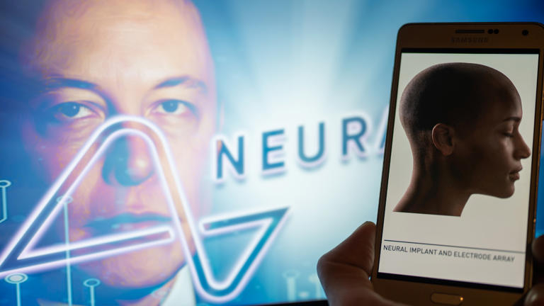 Elon Musk: Neuralink ha installato il primo impianto cerebrale su essere umano