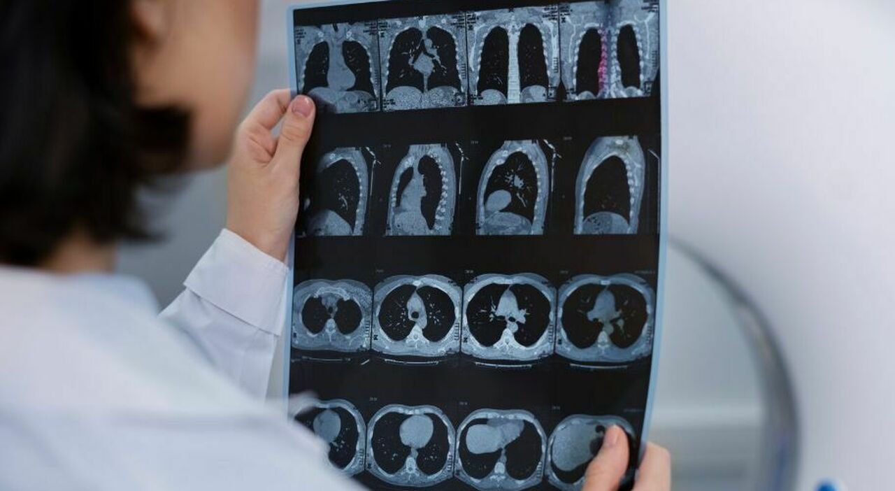 Trapianto combinato a Torino, salvato 32enne con organi invertiti Trapianto combinato a Torino, salvato 32enne con organi invertiti