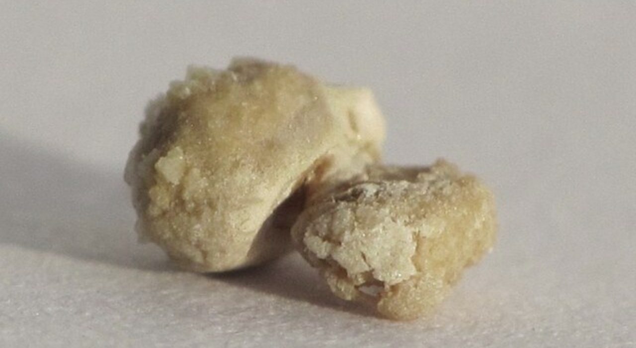 Furto a Pordenone, ladri portano via calcoli renali scambiandoli per pepite Furto a Pordenone, ladri portano via calcoli renali scambiandoli per pepite