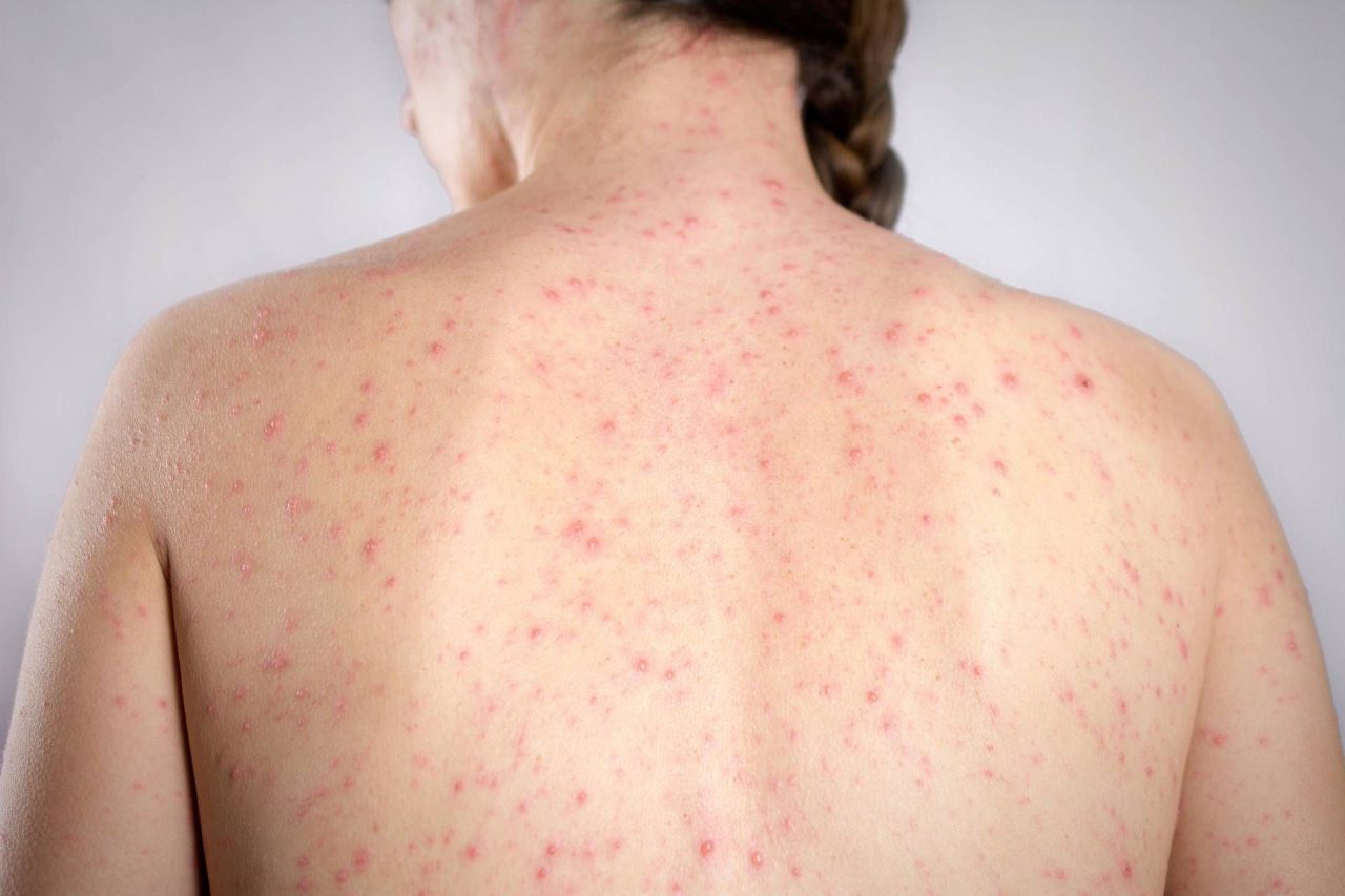 Morbillo in aumento tra Usa e Europa, focolai nelle scuole e allarmi negli aeroporti Morbillo in aumento tra Usa e Europa, focolai nelle scuole e allarmi negli aeroporti