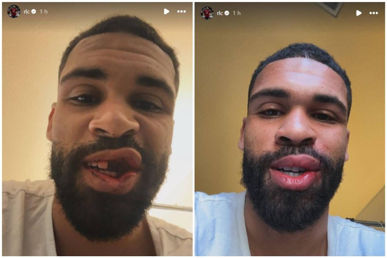 Loftus-Cheek operato alla mascella dopo Milan-Parma