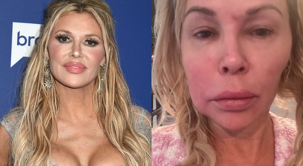 Brandi Glanville, tre anni di sintomi e diagnosi sbagliate prima di scoprire la protesi rotta Brandi Glanville, tre anni di sintomi e diagnosi sbagliate prima di scoprire la protesi rotta