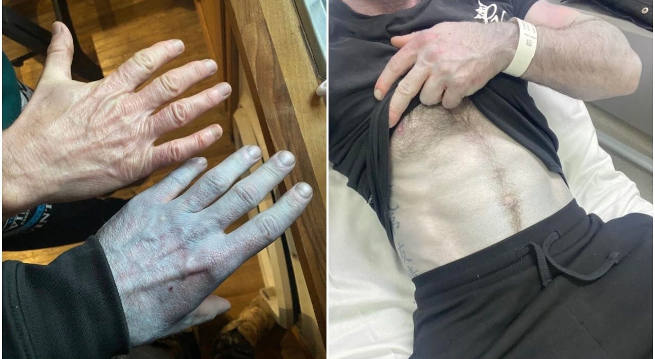 Uomo si sveglia blu nel Derbyshire, colpa delle lenzuola nuove non lavate