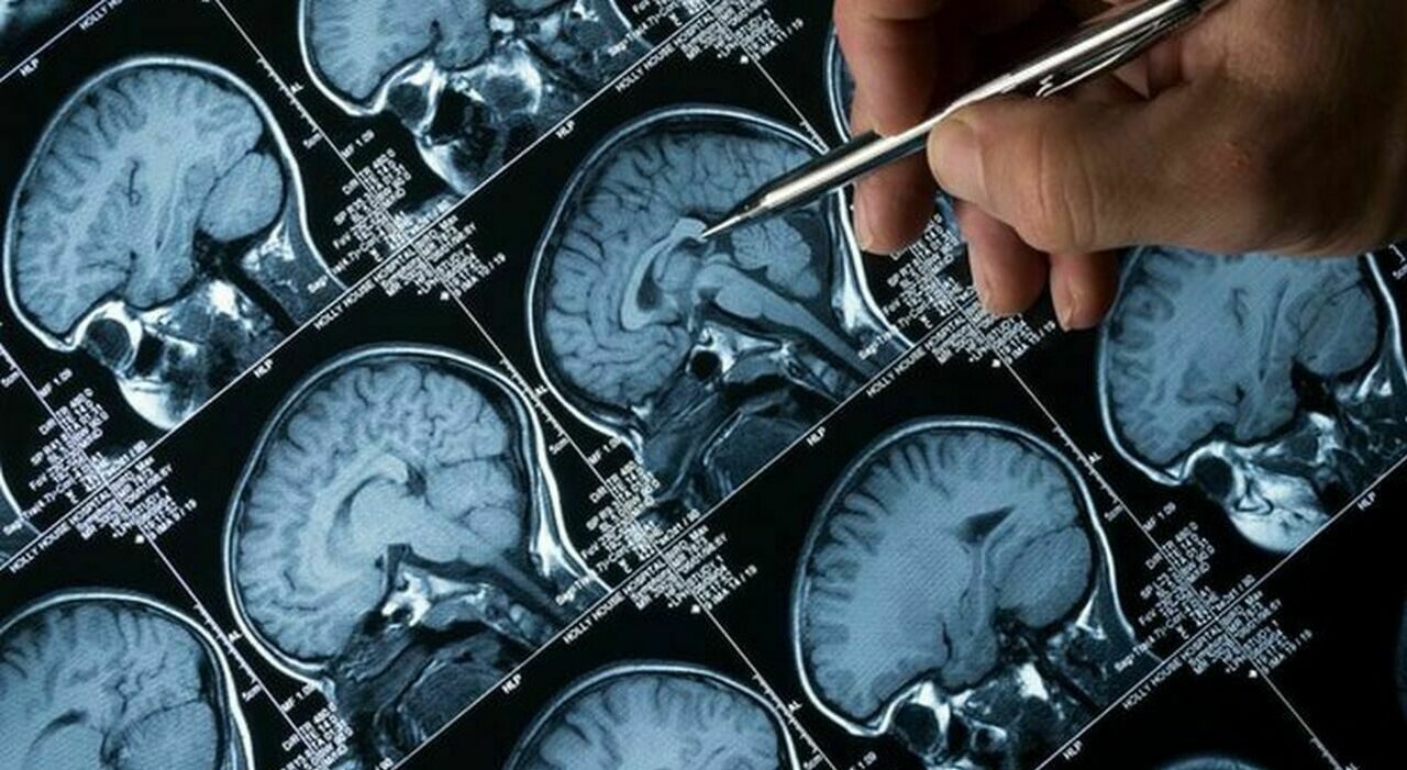Alzheimer, il linguaggio lento può segnalare il declino cognitivo Alzheimer, il linguaggio lento può segnalare il declino cognitivo