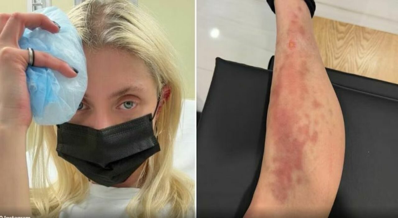 Taylor Momsen morsa da un ragno velenoso in Messico, ricoverata prima del concerto con gli ACDC