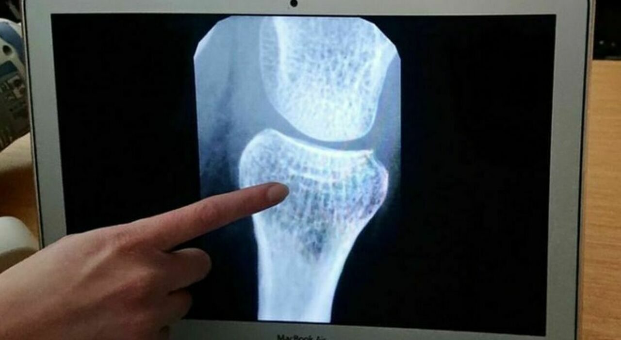 Osteoporosi nelle donne in menopausa, aumenta il rischio di morte precoce e demenza Osteoporosi nelle donne in menopausa, aumenta il rischio di morte precoce e demenza