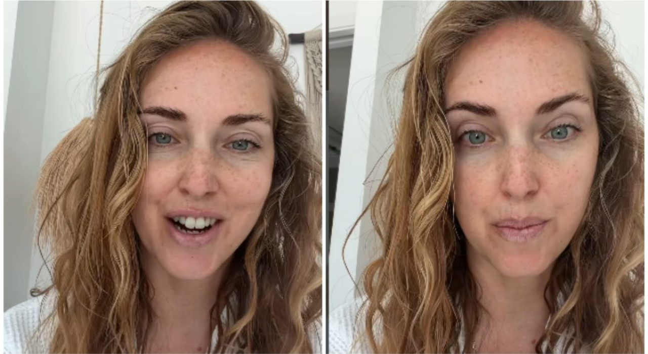 Chiara Ferragni racconta i ritocchi estetici, dal botox al filler rimosso sotto gli occhi