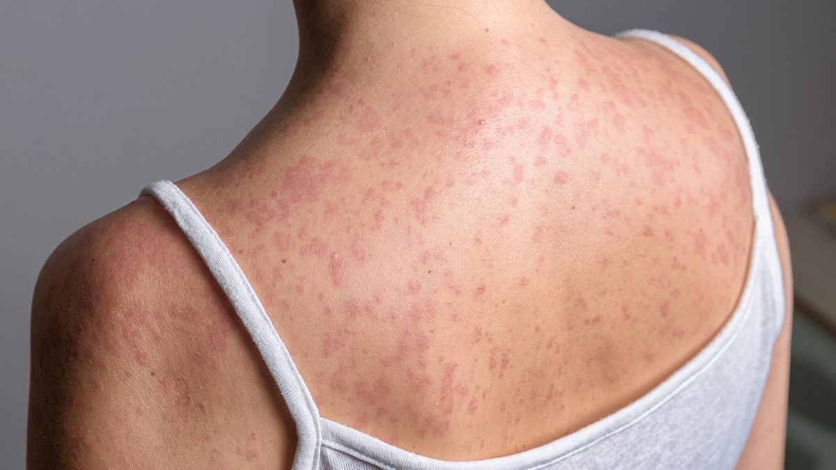Morbillo in Italia, 472 casi confermati in cinque mesi: aumenti forti in Calabria e Campania