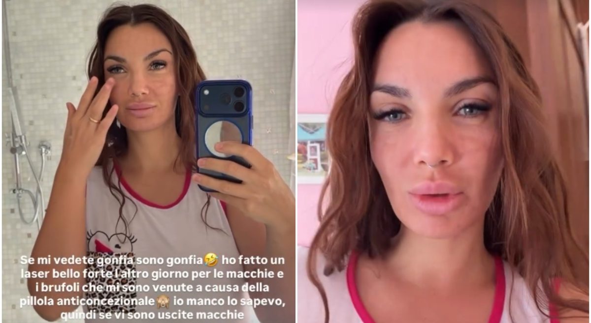 Elettra Lamborghini mostra il viso gonfio dopo il laser: il racconto sulla pillola anticoncezionale