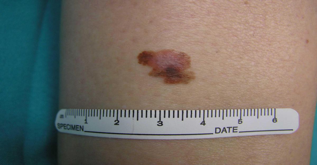 Cancro - oncologo: Tre anni per vaccino mRna contro melanoma