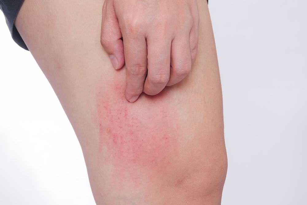 Consigli sulla prevenzione della dermatite da contatto