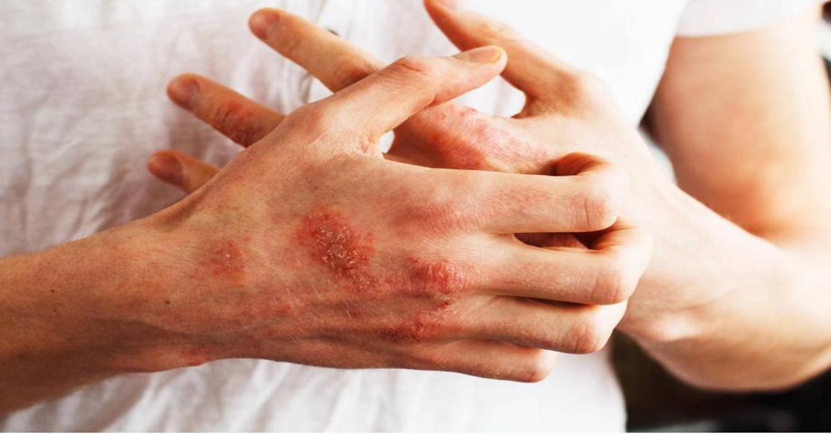 Psoriasi a placche - studio conferma efficacia terapia orale deucravacitinib