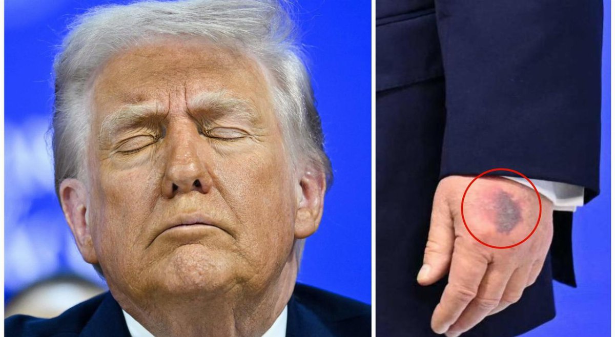 Donald Trump, lividi alle mani e frasi controverse: cresce l Donald Trump, lividi alle mani e frasi controverse: cresce l